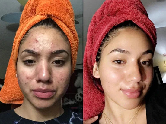 Eloura Rice Peel Serum Ampoule™